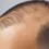 Dermopigmentation : comprendre ses applications et ses bienfaits